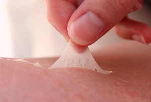 sunburn-peeling